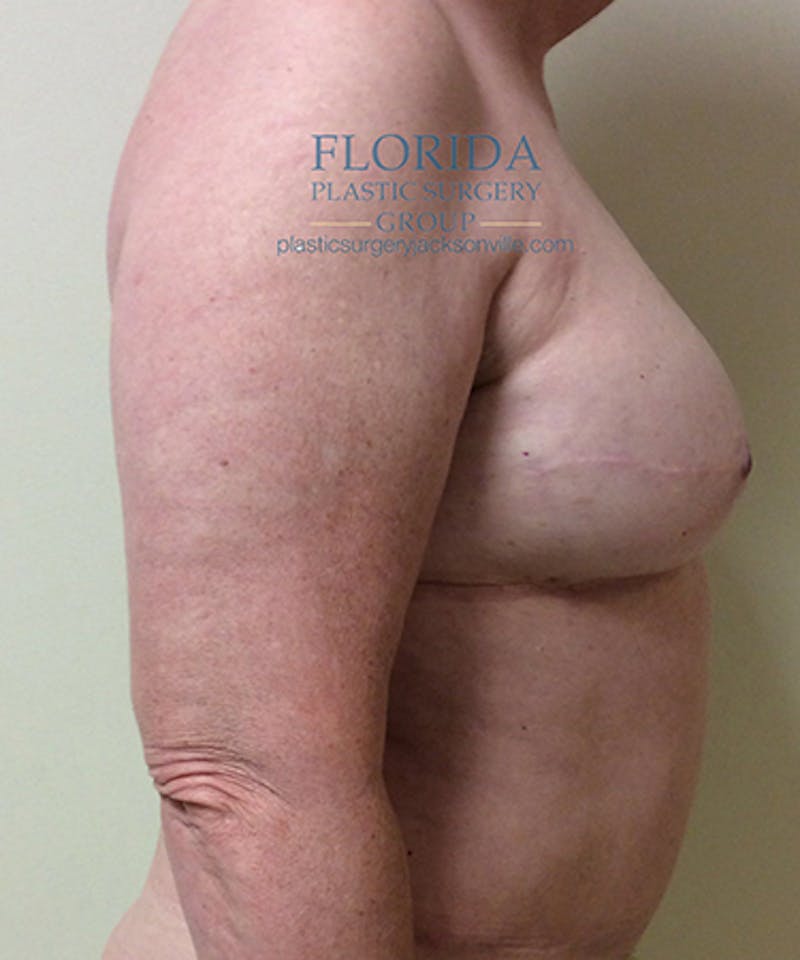 DIEP Flap Reconstruction Before & After Gallery - Patient 154948874 - Image 6