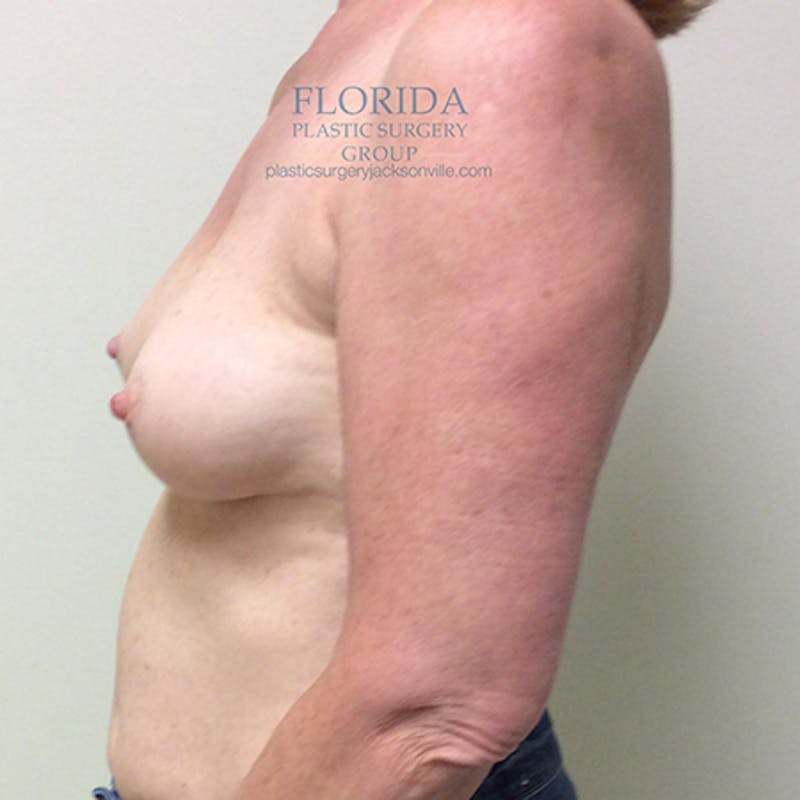 Nipple Sparing Breast Reconstruction Before & After Gallery - Patient 154948881 - Image 3