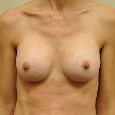 Silicone Breast Augmentation Before & After Gallery - Patient 154948869 - Image 2