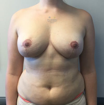 Breast Implant Removal Before & After Gallery - Patient 154948877 - Image 2
