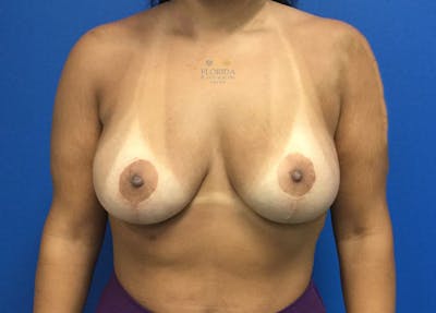 Augmentation Mastopexy Before & After Gallery - Patient 154948872 - Image 2