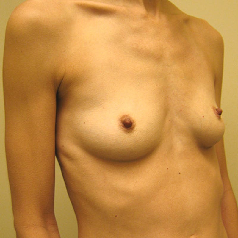 Silicone Breast Augmentation Before & After Gallery - Patient 154948869 - Image 3