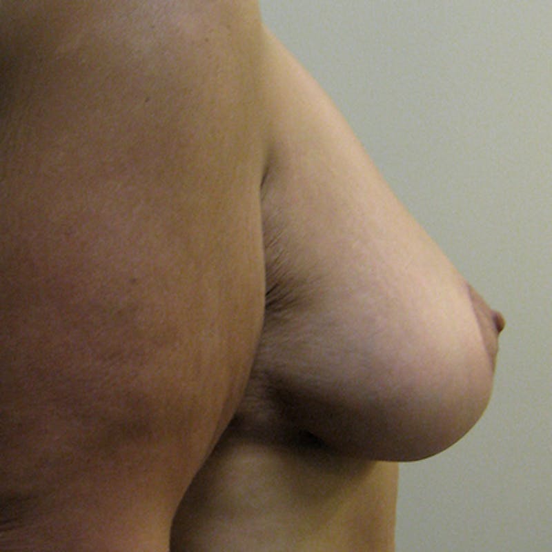 Breast Lift Before & After Gallery - Patient 154948867 - Image 6