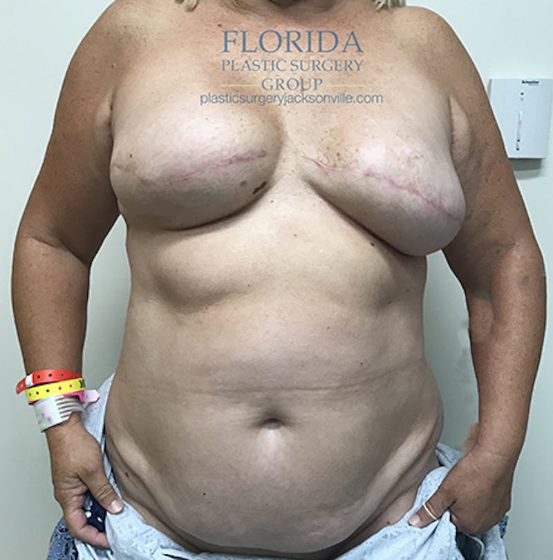 Breast Reconstruction Revision Before & After Gallery - Patient 154948884 - Image 1