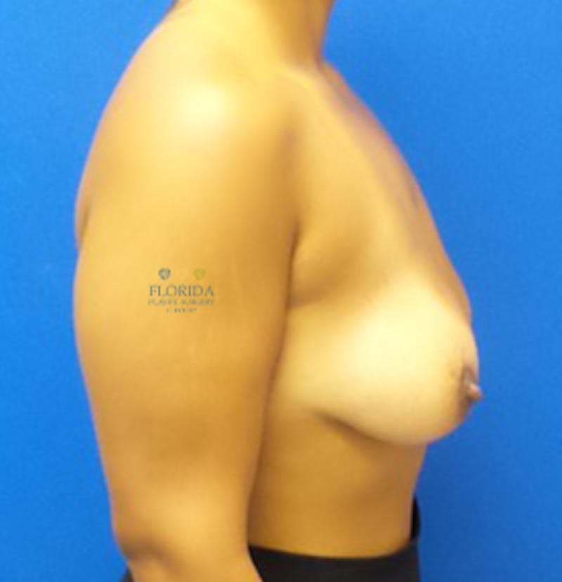 Augmentation Mastopexy Before & After Gallery - Patient 154948872 - Image 3