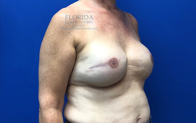 Latissimus Flap Reconstruction Before & After Gallery - Patient 154948868 - Image 6