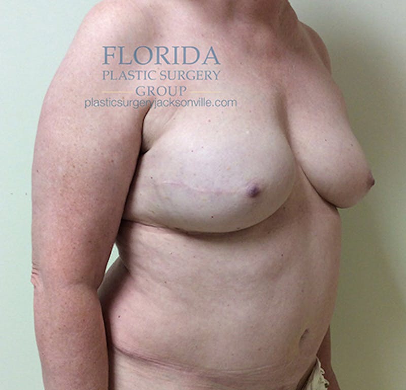 DIEP Flap Reconstruction Before & After Gallery - Patient 154948874 - Image 8
