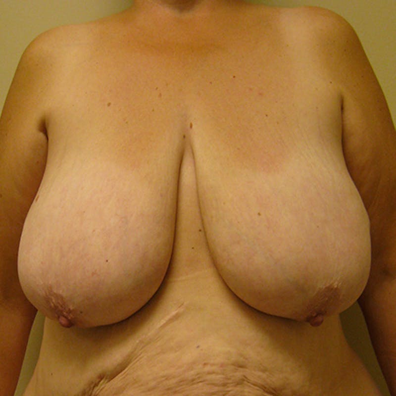 Breast Lift Before & After Gallery - Patient 154948875 - Image 1