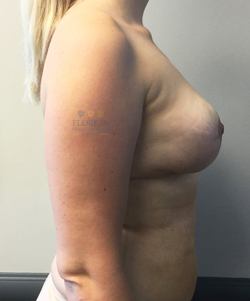 Breast Implant Removal Before & After Gallery - Patient 154948877 - Image 4