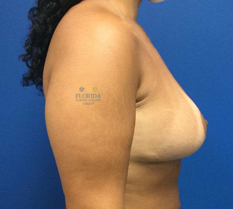 Augmentation Mastopexy Before & After Gallery - Patient 154948872 - Image 4