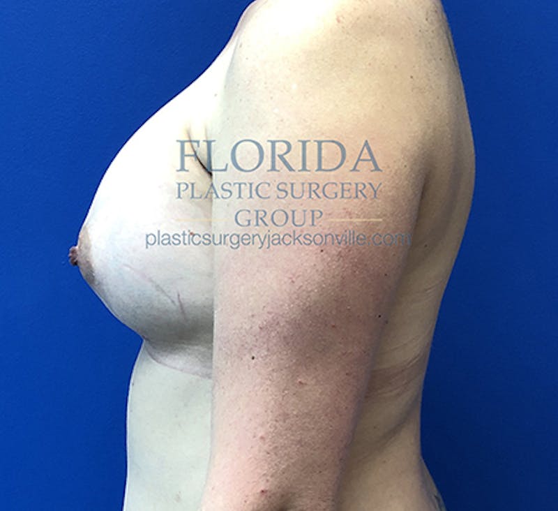 Saline Breast Augmentation Before & After Gallery - Patient 154948876 - Image 8