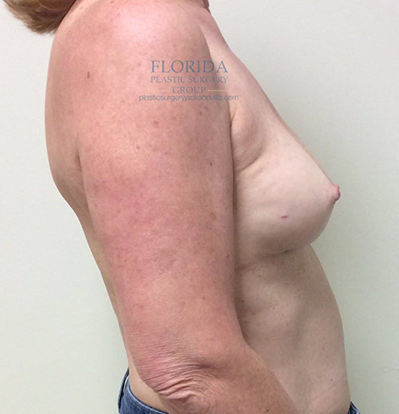 Nipple Sparing Breast Reconstruction Before & After Gallery - Patient 154948881 - Image 7