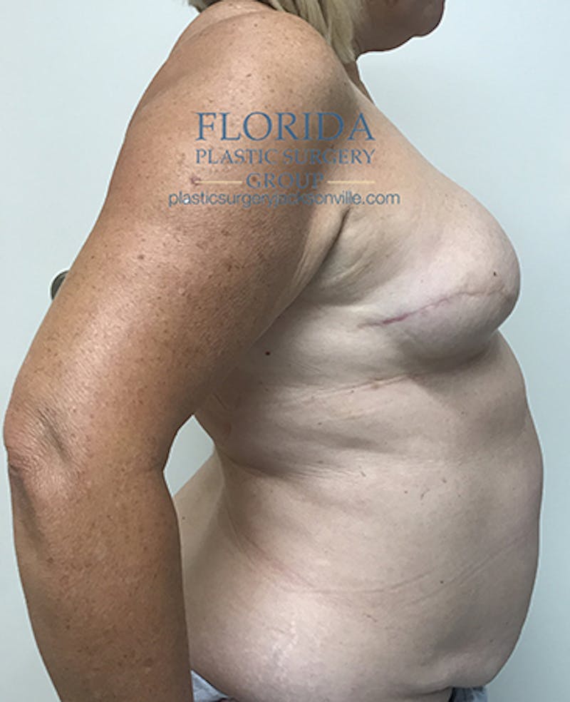 Breast Reconstruction Revision Before & After Gallery - Patient 154948884 - Image 3