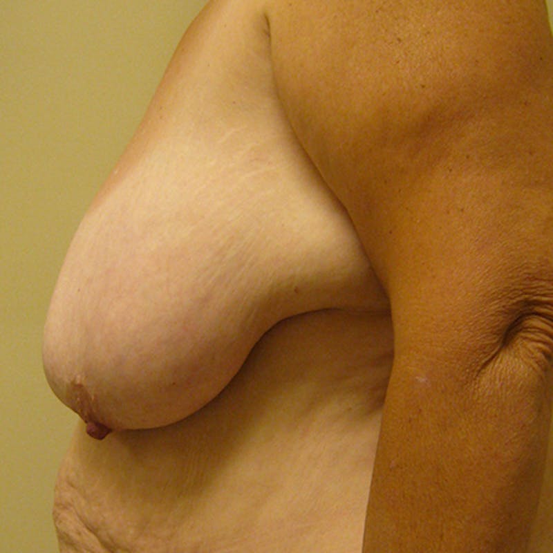 Breast Lift Before & After Gallery - Patient 154948875 - Image 3