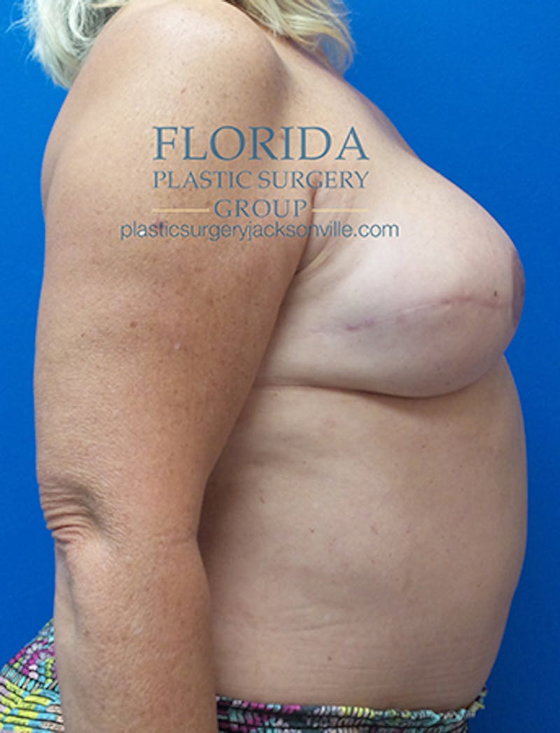 Breast Reconstruction Revision Before & After Gallery - Patient 154948884 - Image 4