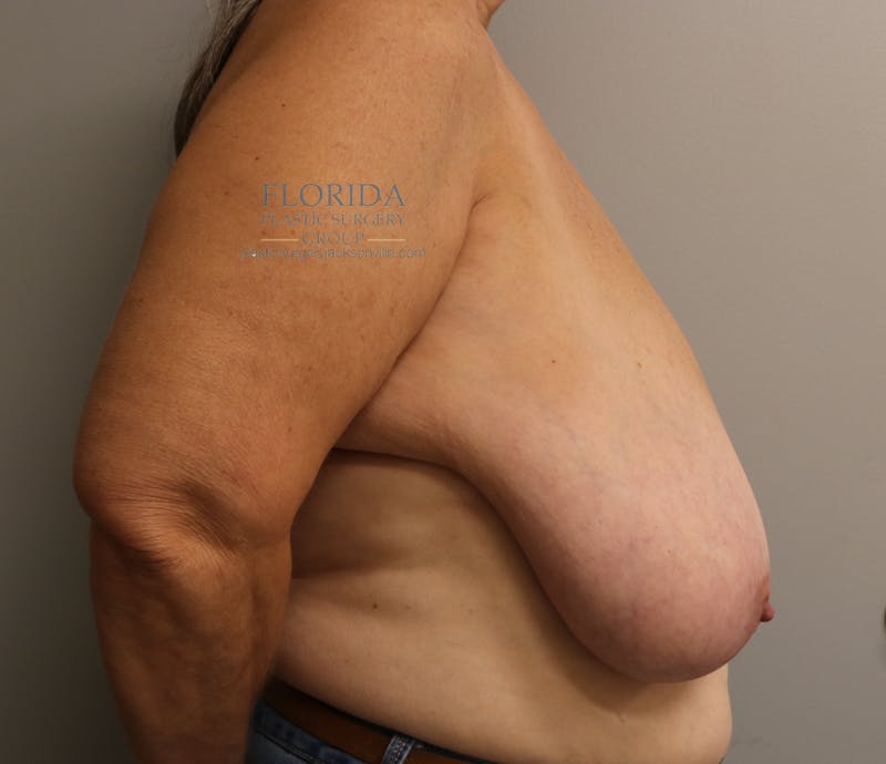 Post Lumpectomy Reconstruction Before & After Gallery - Patient 154948880 - Image 3