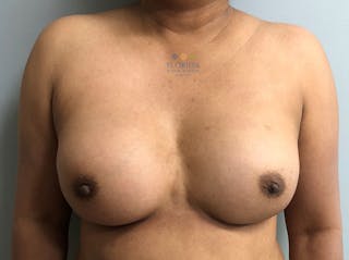 Tissue Expander Reconstruction Before & After Gallery - Patient 154948886 - Image 2