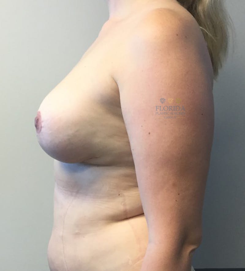 Breast Implant Removal Before & After Gallery - Patient 154948877 - Image 6