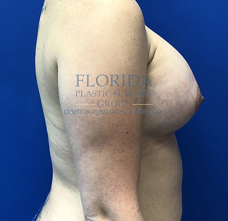 Saline Breast Augmentation Before & After Gallery - Patient 154948876 - Image 10