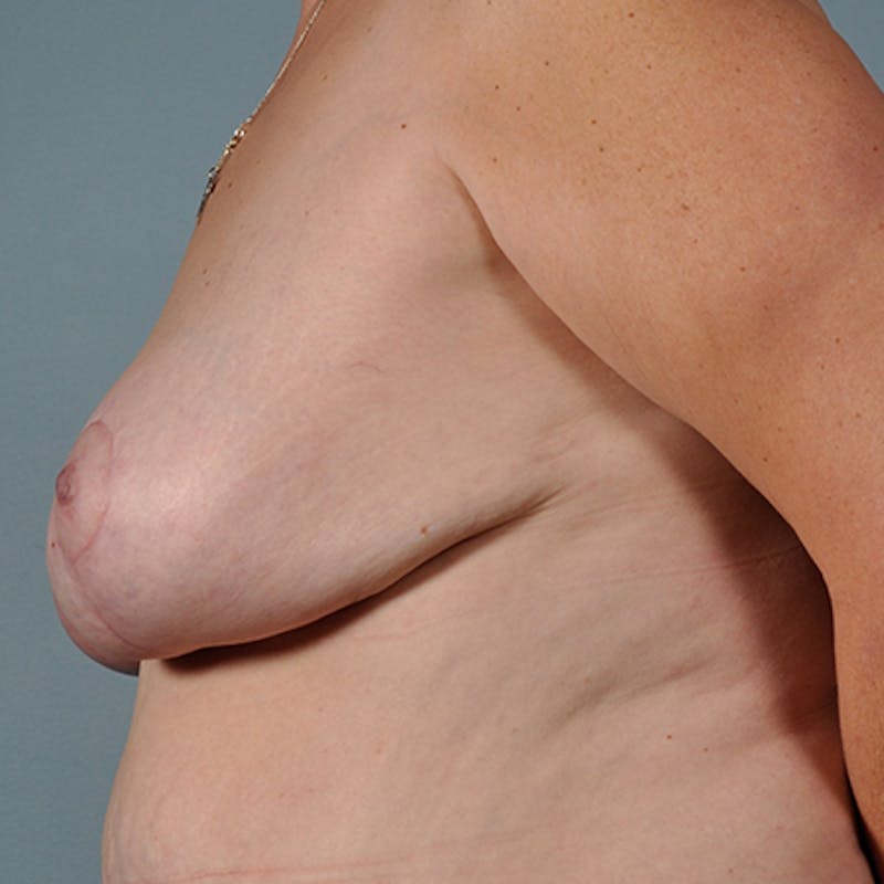 Breast Lift Before & After Gallery - Patient 154948875 - Image 4