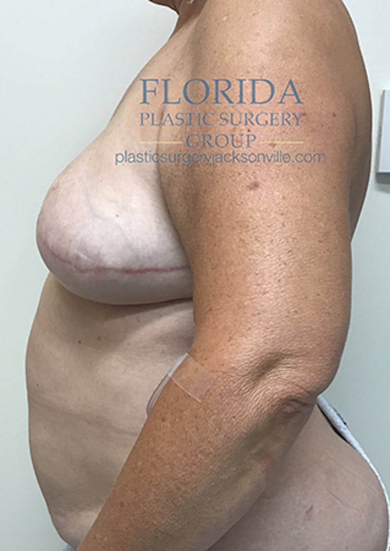 Breast Reconstruction Revision Before & After Gallery - Patient 154948884 - Image 5