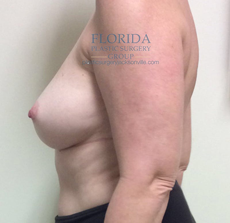 Direct to Implant Breast Reconstruction Before & After Gallery - Patient 154948891 - Image 3