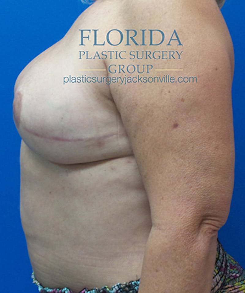 Breast Reconstruction Revision Before & After Gallery - Patient 154948884 - Image 6