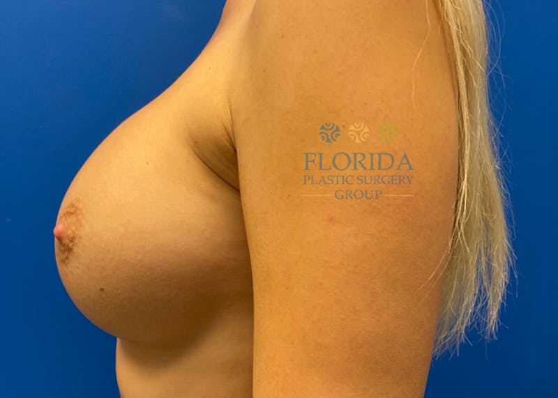 Silicone Breast Augmentation Before & After Gallery - Patient 154948883 - Image 4