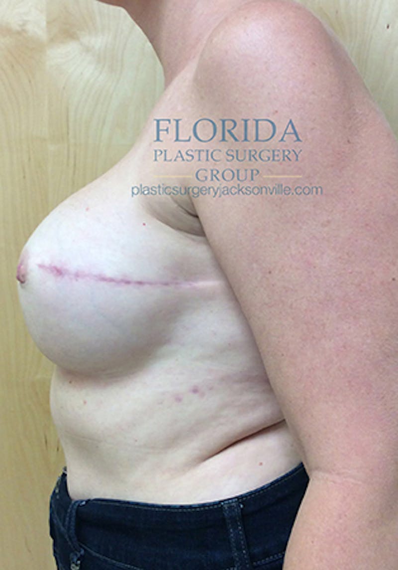 Direct to Implant Breast Reconstruction Before & After Gallery - Patient 154948891 - Image 4
