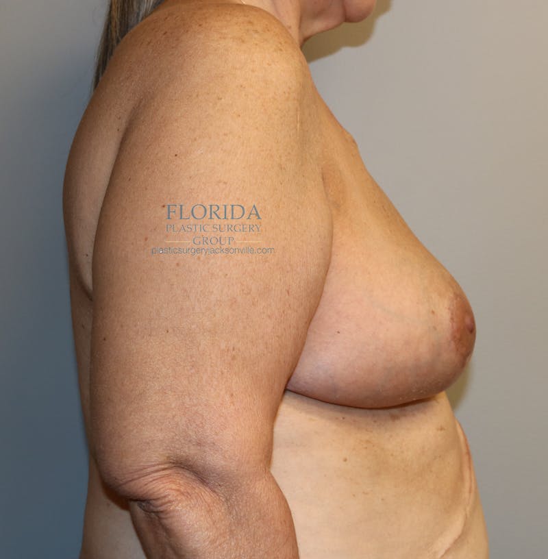 Post Lumpectomy Reconstruction Before & After Gallery - Patient 154948880 - Image 4