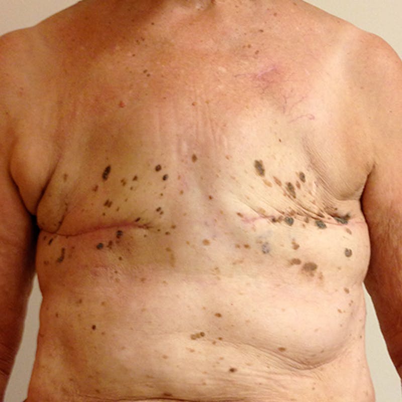 Latissimus Flap Reconstruction Before & After Gallery - Patient 154948888 - Image 1