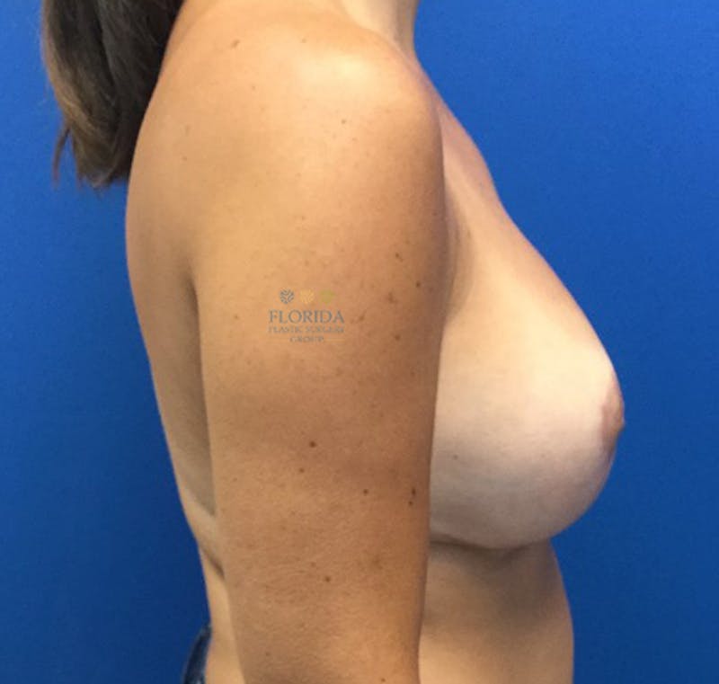 Breast Reduction Before & After Gallery - Patient 154948887 - Image 4
