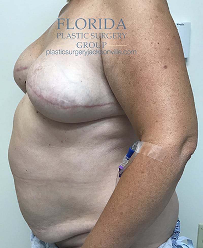 Breast Reconstruction Revision Before & After Gallery - Patient 154948884 - Image 7