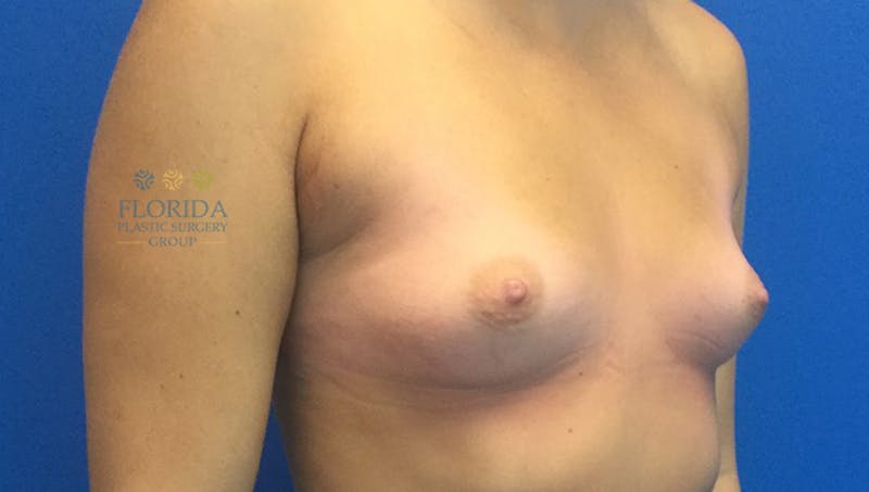 Silicone Breast Augmentation Before & After Gallery - Patient 154948883 - Image 5