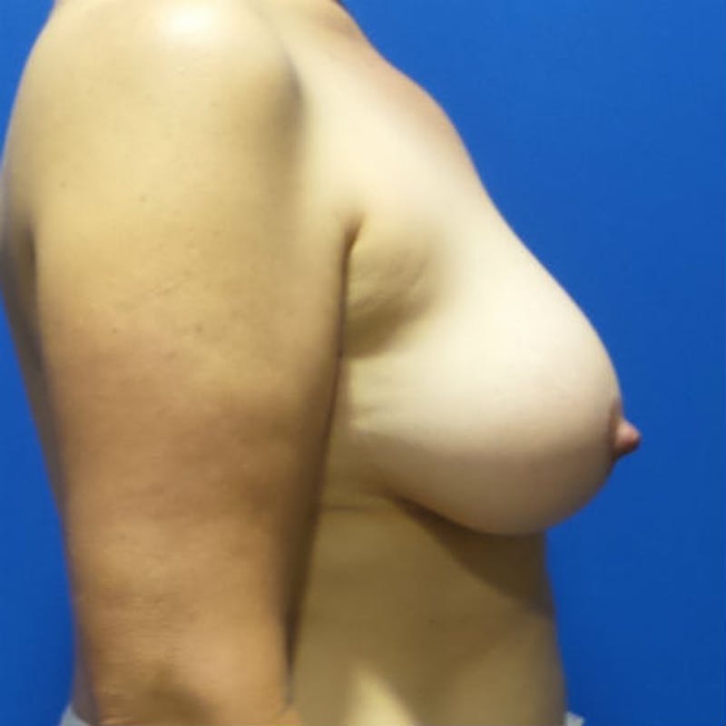 DIEP Flap Reconstruction Before & After Gallery - Patient 154948882 - Image 5