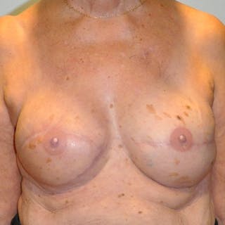Latissimus Flap Reconstruction Before & After Gallery - Patient 154948888 - Image 2