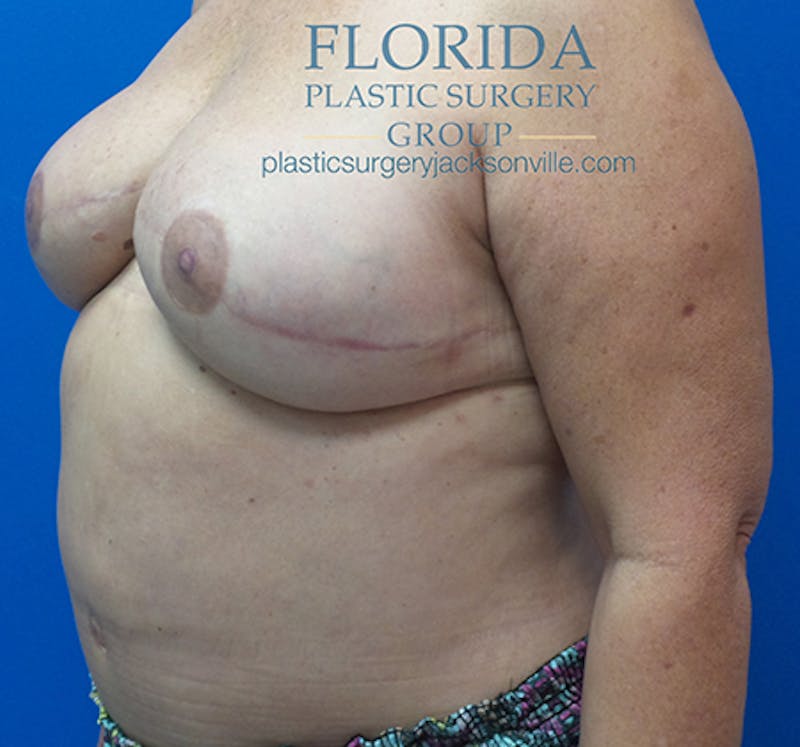 Breast Reconstruction Revision Before & After Gallery - Patient 154948884 - Image 8