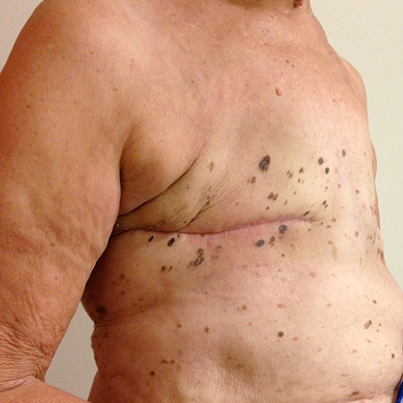 Latissimus Flap Reconstruction Before & After Gallery - Patient 154948888 - Image 3