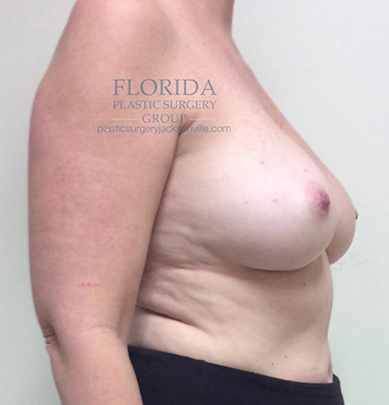 Direct to Implant Breast Reconstruction Before & After Gallery - Patient 154948891 - Image 7