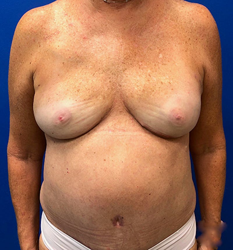 Nipple Sparing Breast Reconstruction Before & After Gallery - Patient 154948897 - Image 2