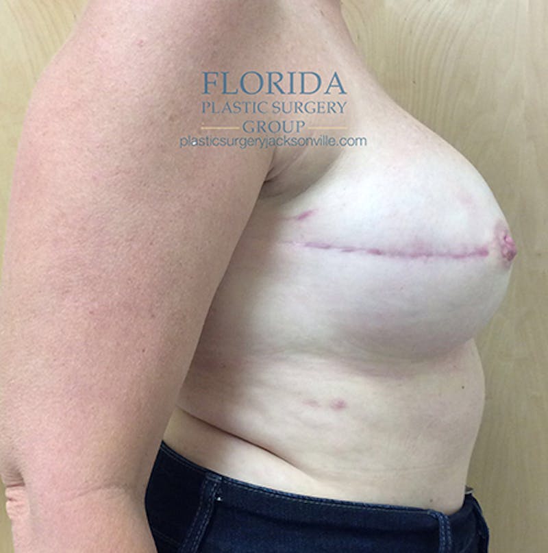 Direct to Implant Breast Reconstruction Before & After Gallery - Patient 154948891 - Image 8