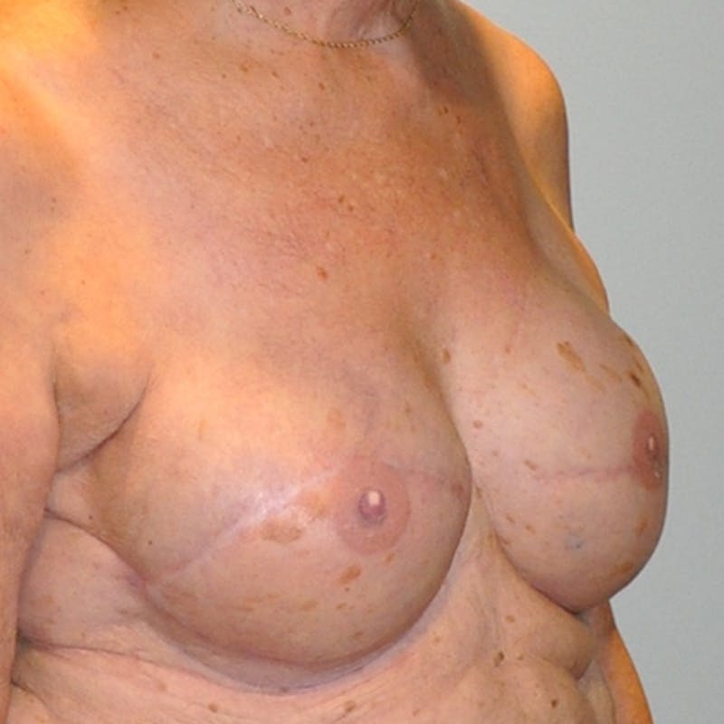 Latissimus Flap Reconstruction Before & After Gallery - Patient 154948888 - Image 4