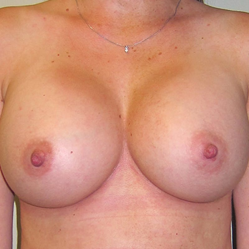 Silicone Breast Augmentation Before & After Gallery - Patient 154948893 - Image 2