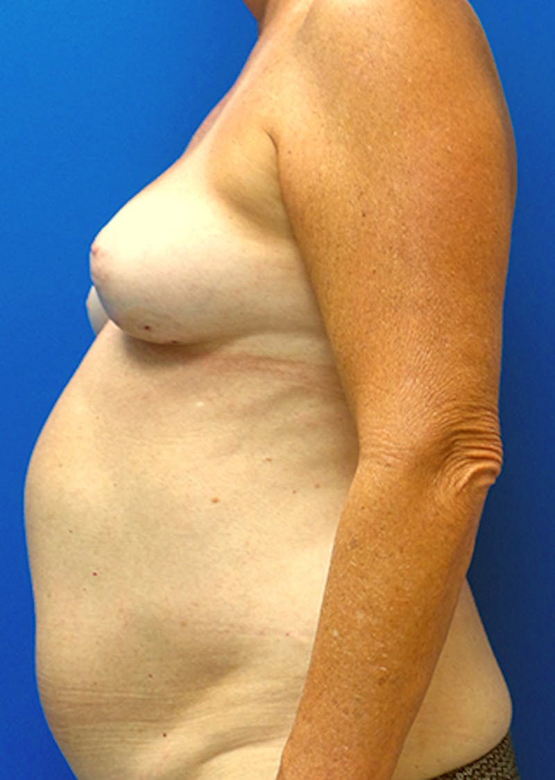 Nipple Sparing Breast Reconstruction Before & After Gallery - Patient 154948897 - Image 3