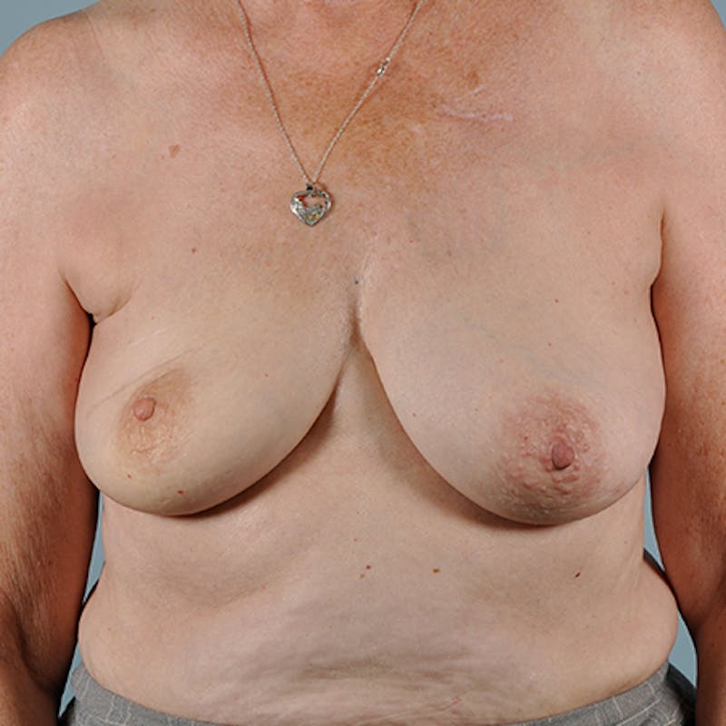 Latissimus Flap Reconstruction Before & After Gallery - Patient 154948900 - Image 1