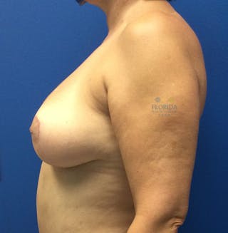 Post Lumpectomy Reconstruction Before & After Gallery - Patient 154948896 - Image 4
