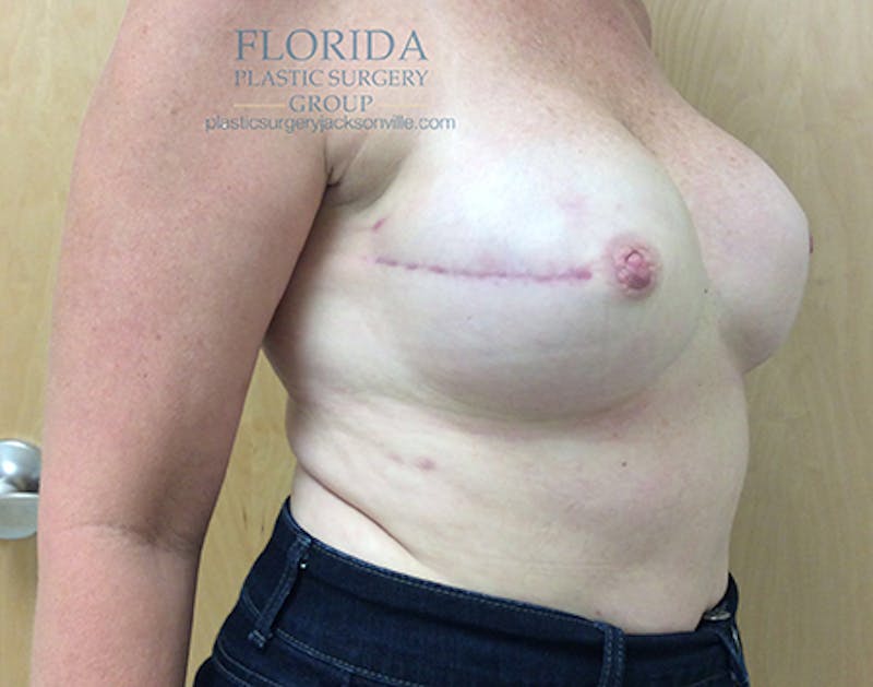 Direct to Implant Breast Reconstruction Before & After Gallery - Patient 154948891 - Image 10
