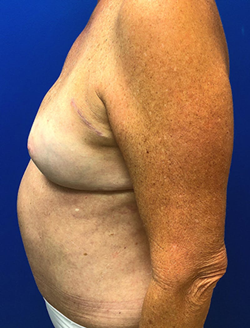 DIEP Flap Reconstruction Before & After Gallery - Patient 154948901 - Image 4