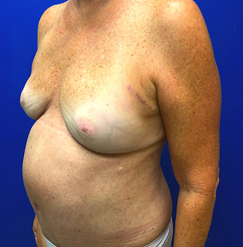 Nipple Sparing Breast Reconstruction Before & After Gallery - Patient 154948897 - Image 6