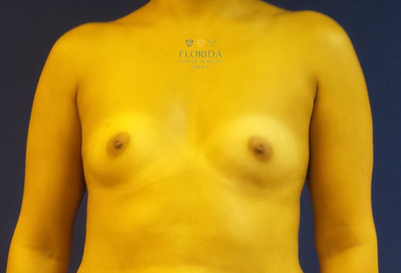 Saline Breast Augmentation Before & After Gallery - Patient 154948909 - Image 1